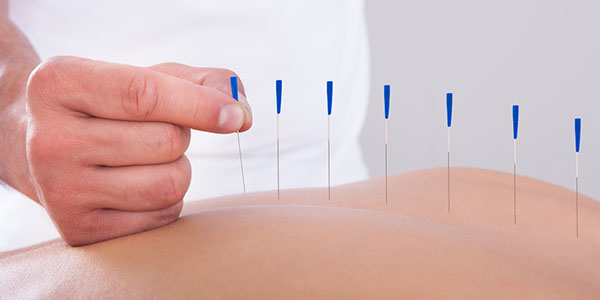 Acupuncture Acupuncture